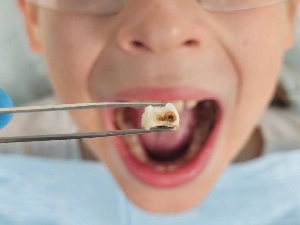 Best Dental Abscess Treatment in Bouse, AZ